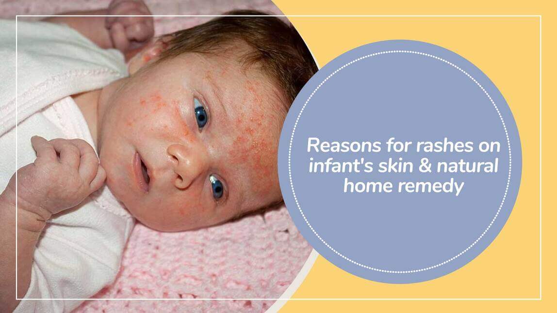Reasons for rashes on Infant Skins and How to treat them naturally at Home ?